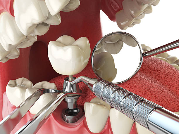 Best Emergency Wisdom Tooth Extraction in Upper Ack, NY